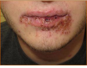 Eczema Herpeticum and Impetigo: What's the Common Underlying Problem?
