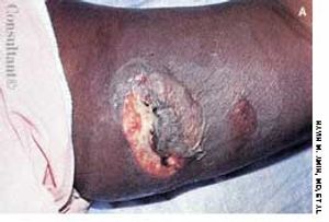 Brown Recluse Spider Bite in a 42-Year-Old Woman