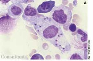 Visceral Leishmaniasis