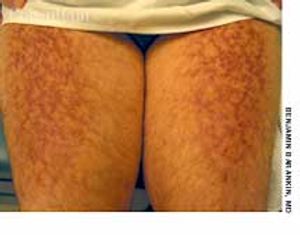 Erythema ab Igne on the Thighs of a 53-Year-Old Man