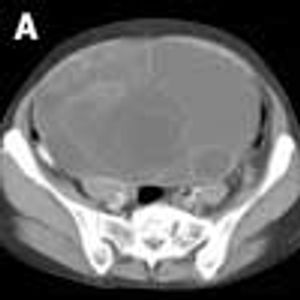 Mucinous Cystadenoma