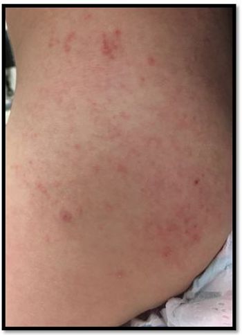 Hand, foot, and mouth disease, coxsackie virus