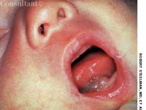 Congenital Ranula