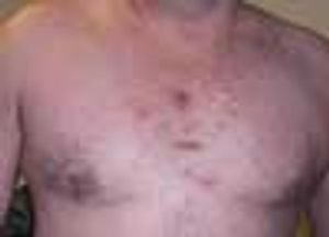 Hidradenitis Suppurativa