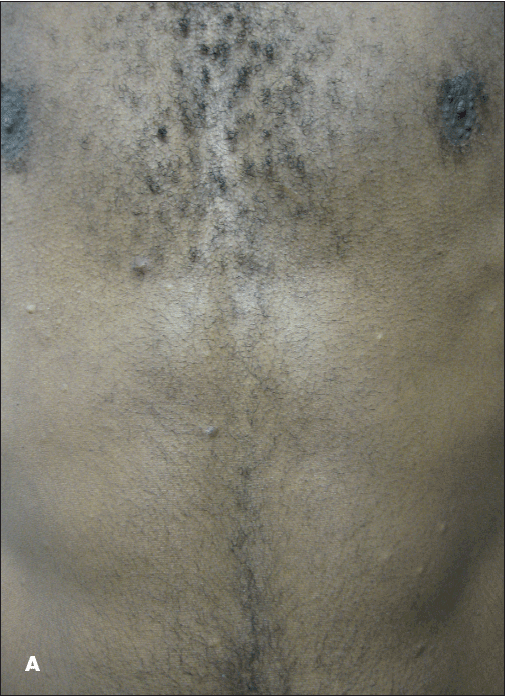 Eruptive Vellus Hair Cysts