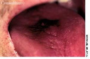 Aspergillosis
