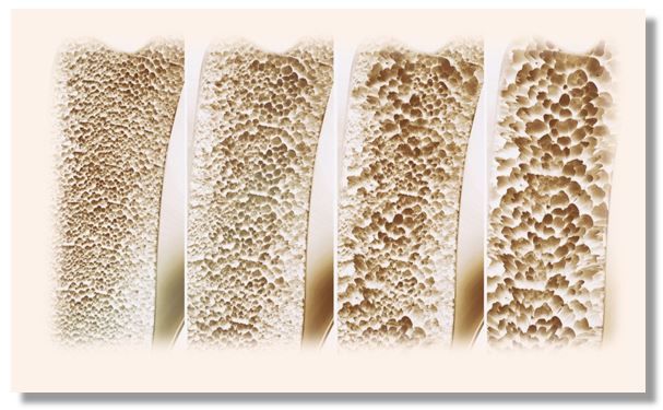 Guideline-directed Osteoporosis Treatment Found in Decline 