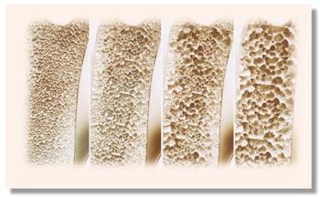 Osteoporosis medication use declining 