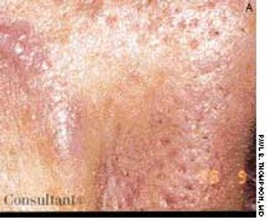 Desmoplastic Melanoma