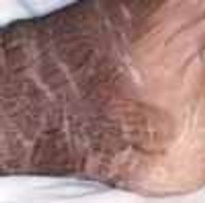 Elephantiasis Nostras Verrucosa