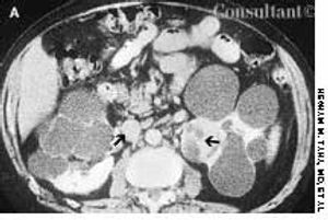 Acquired Cystic Kidney Disease and Renal Cell Carcinoma