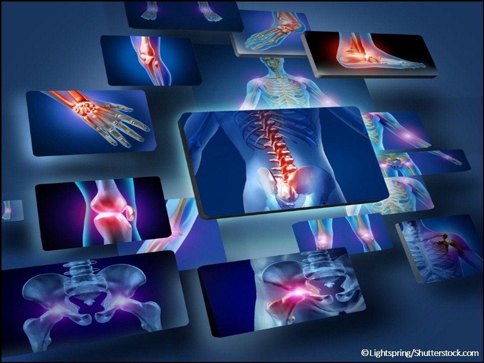 Hyrimoz (adalimumab-adaz) Injection, arthritis, Crohn's, plaque psoriasis