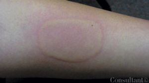 Idiopathic Cold Urticaria