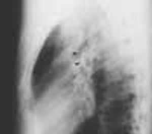 Esophageal Foregut Cyst Presenting as Suprahilar Mass