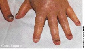 Docetaxel-Related Onycholysis