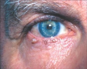 eyelid lesion