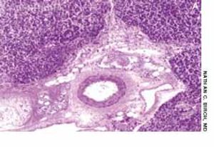 Acute Disseminated Histoplasmosis in a 48-Year-Old Man