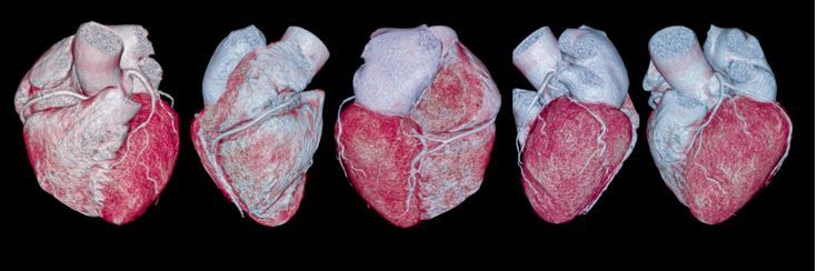 Coronary artery visible on 3D rendering of CCTA. ©samunella/stock.adobe.com