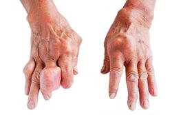 Excess Weight and Genetics May Put Women at Higher Risk of Gout