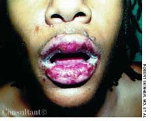 Erythema Multiforme in a 28-Year-Old Man