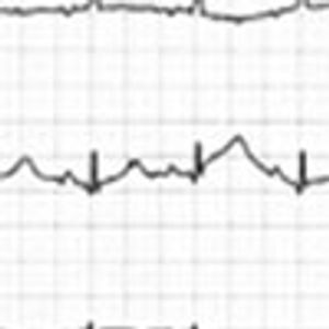 Apical Ballooning Syndrome