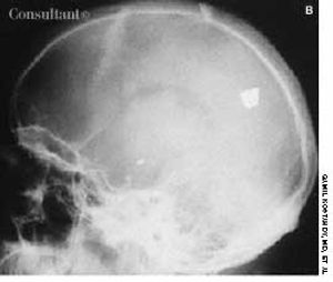 Bullet in the Brain