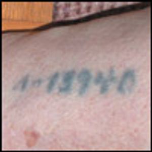 Holocaust Survivor: An Incidental Finding