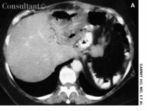 Liver Abscess