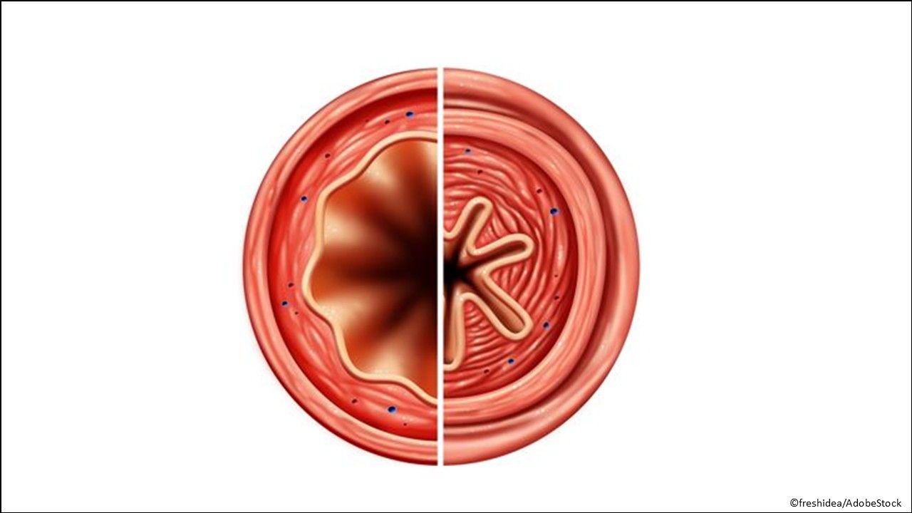 Asthma maintenance, chronic rhinosinusitis with nasal polyps (CRSwNP), food allergies, urticaria: Omalizumab-igec (Omlyclo). the first FDA-approved anti-IgE biosimilar to omalizumab designated as interchangeable with omalizumab (Xolair)