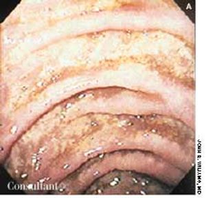 AIDS Patient With Persistent Diarrhea