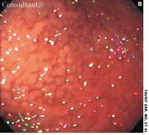 Diffuse Gastric Polyposis