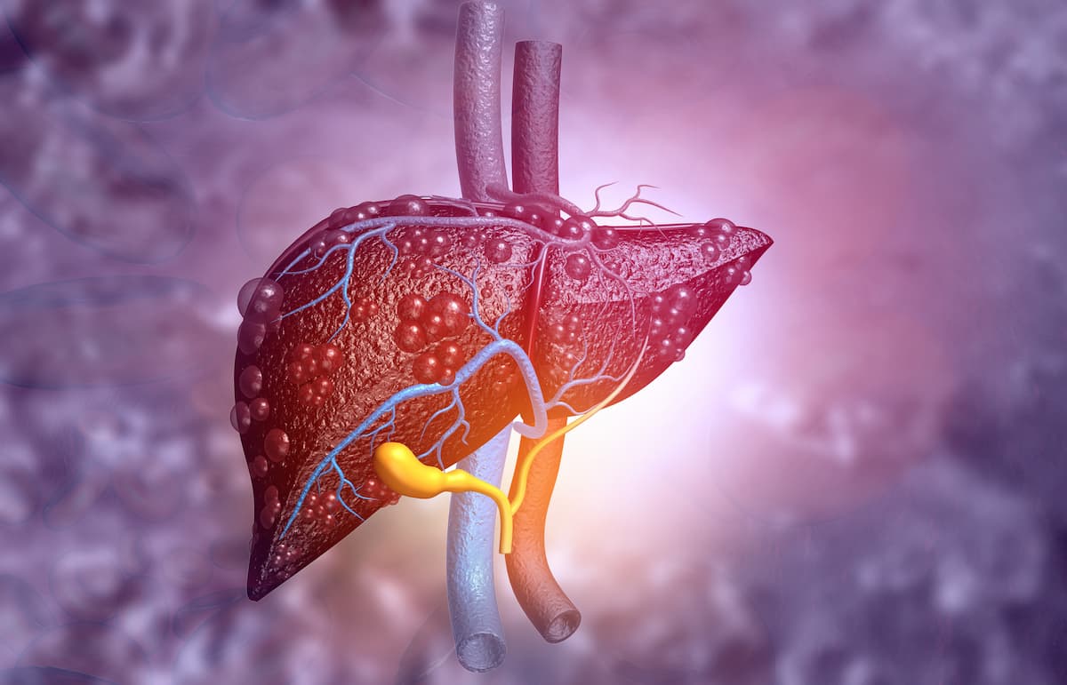 New Data Show Rise in Decompensated Cirrhosis and Hepatic Encephalopathy Cases among US Medicare Beneficiaries