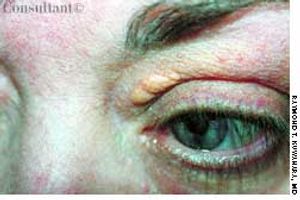 Xanthelasma in a Middle-Aged Man