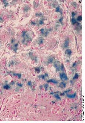 Bronze Skin in Hemochromatosis