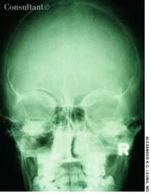 Maxillary Sinusitis