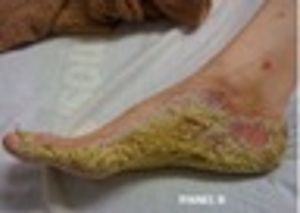 Snapshots of Neurosyphilis