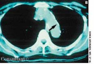 Calcification of the Mediastinum Following Tuberculosis
