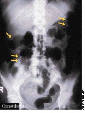 Unusual X-Ray Finding in Pseudomembranous Enterocolitis
