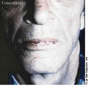 Rendu-Osler-Weber Syndrome