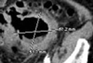 A Case of Giant Colonic Diverticulum