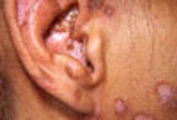 discoid lupus erythematosus