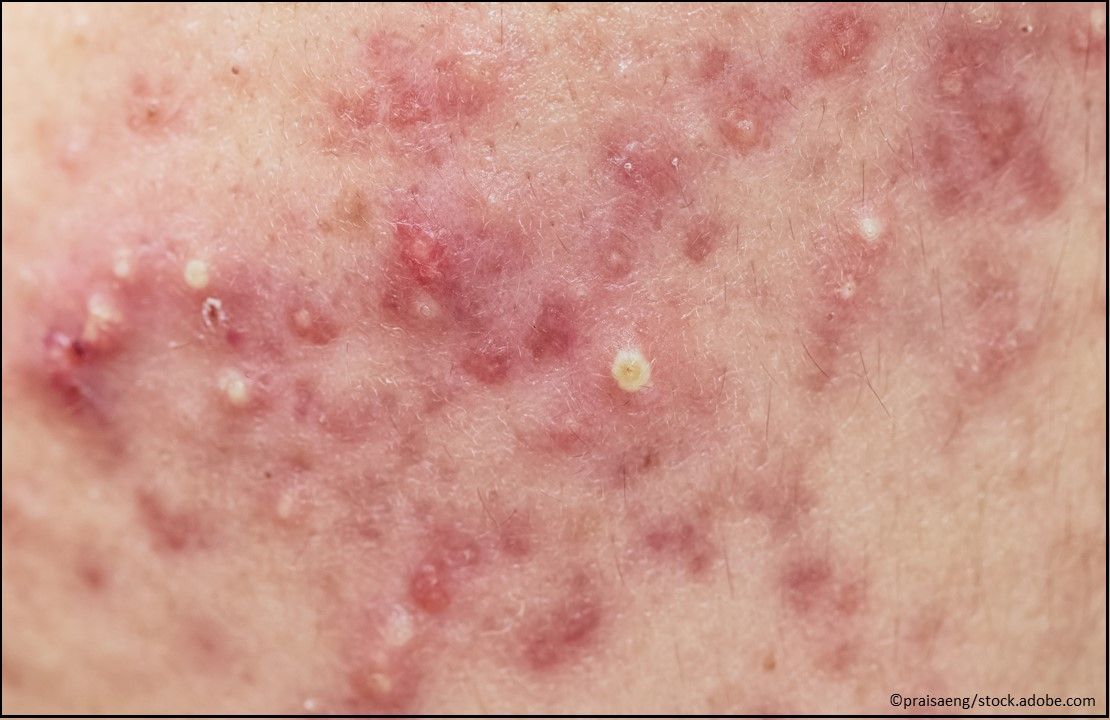 Amzeeq (minocycline) Topical Foam, acne medication, dermatology, acne skin
