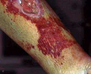 Vibrio vulnificus Infection