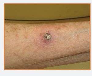 A Painless, Rapidly-growing Nodule in a 74-year-old Woman 