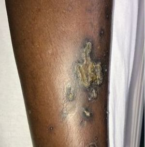 Hyperbilirubinemia and Diffuse Skin Lesions in a Woman with Diabetes, CVD