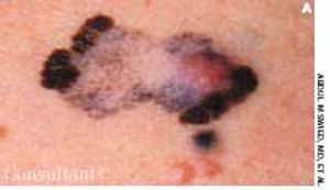 Metastatic Melanoma in an 83-year-old Man