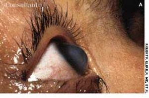 Keratoconus With Corneal Hydrops