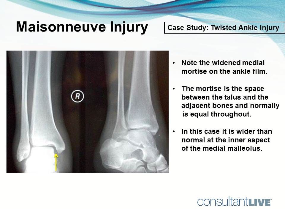 Maisonneuve injury of the ankle 