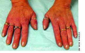 Anorexia Nervosa-Associated Raynaud Phenomenon