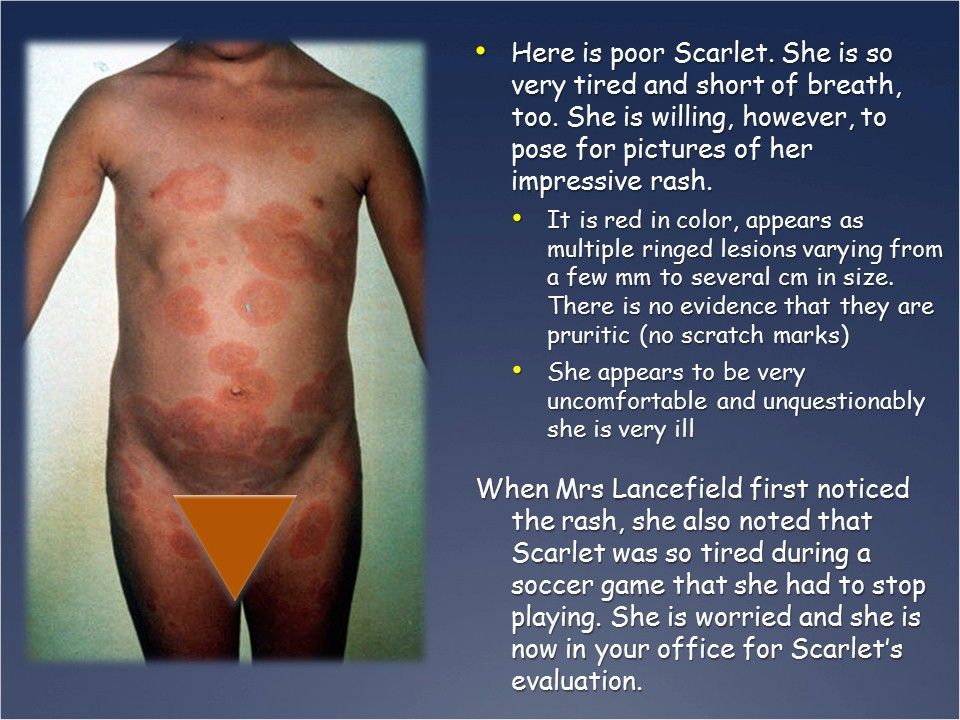 Erythematous eruption appears multiple ringed lesions